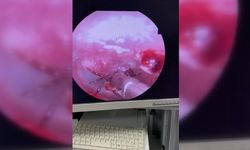 Kulak ağrısıyla hastaneye gitti, kulağından kene çıktı